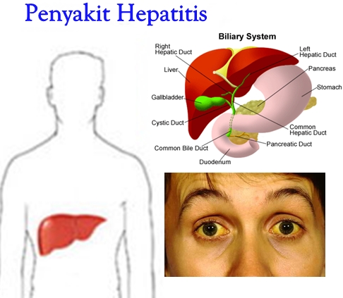 gambar hepatitis 1515